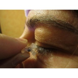 Installation de la pince anti-ptosis de la paupière sur les cils